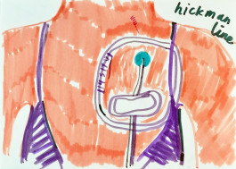 A chest, scribbled in vivid peach felt tip and a purple bra appears vaguely sunburnt, bringing to mind a gaudy beachside Martin Parr photograph . Half the chest is covered in lines and patches which sit below the left bra strap and reach down below the left bra cup and off the bottom of the drawing. In the corner, neat, flowing handwriting informs us that this is a Hickman Line, a tube placed into one of the large veins leading to the heart. 